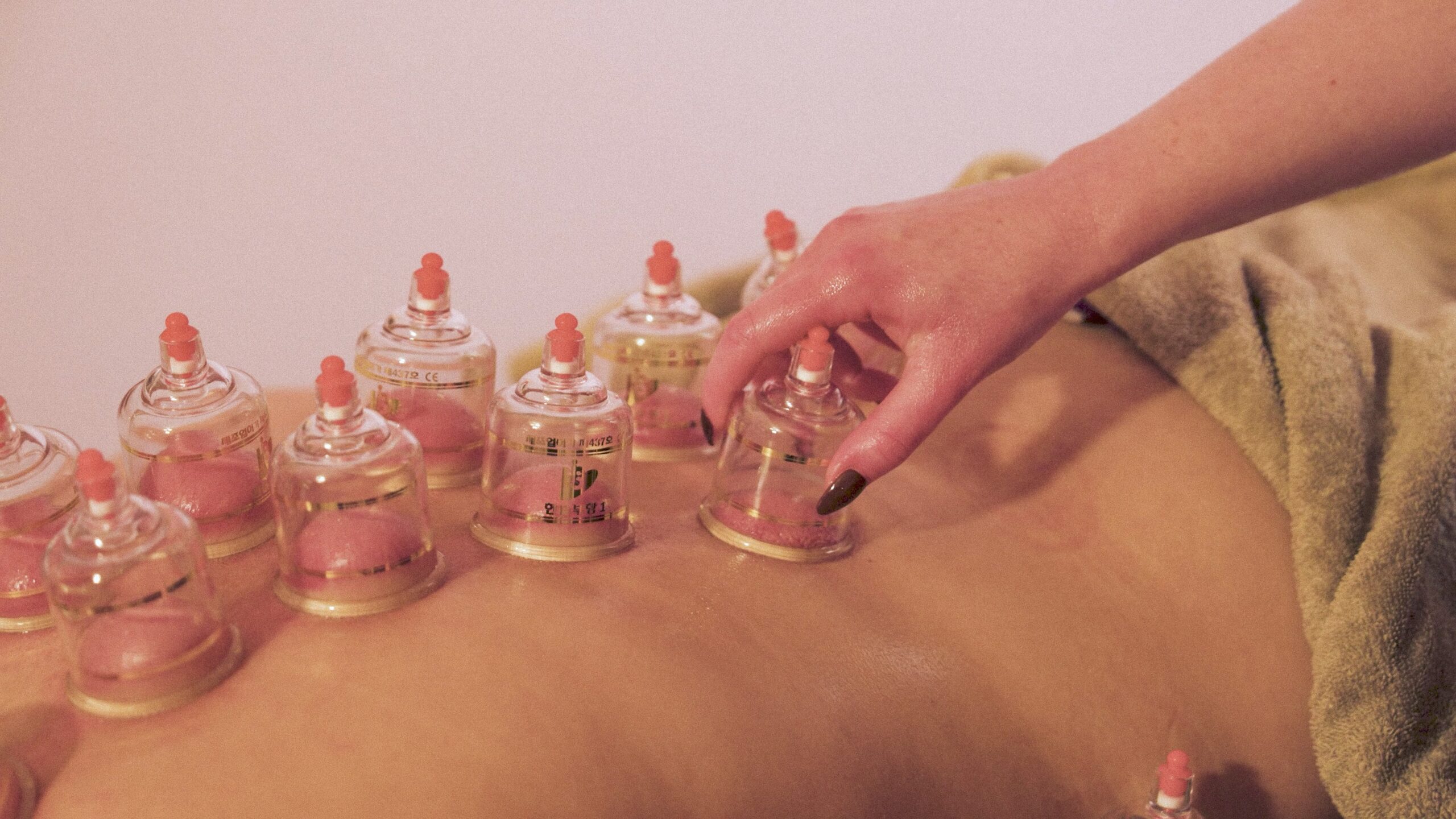Traditional Cupping